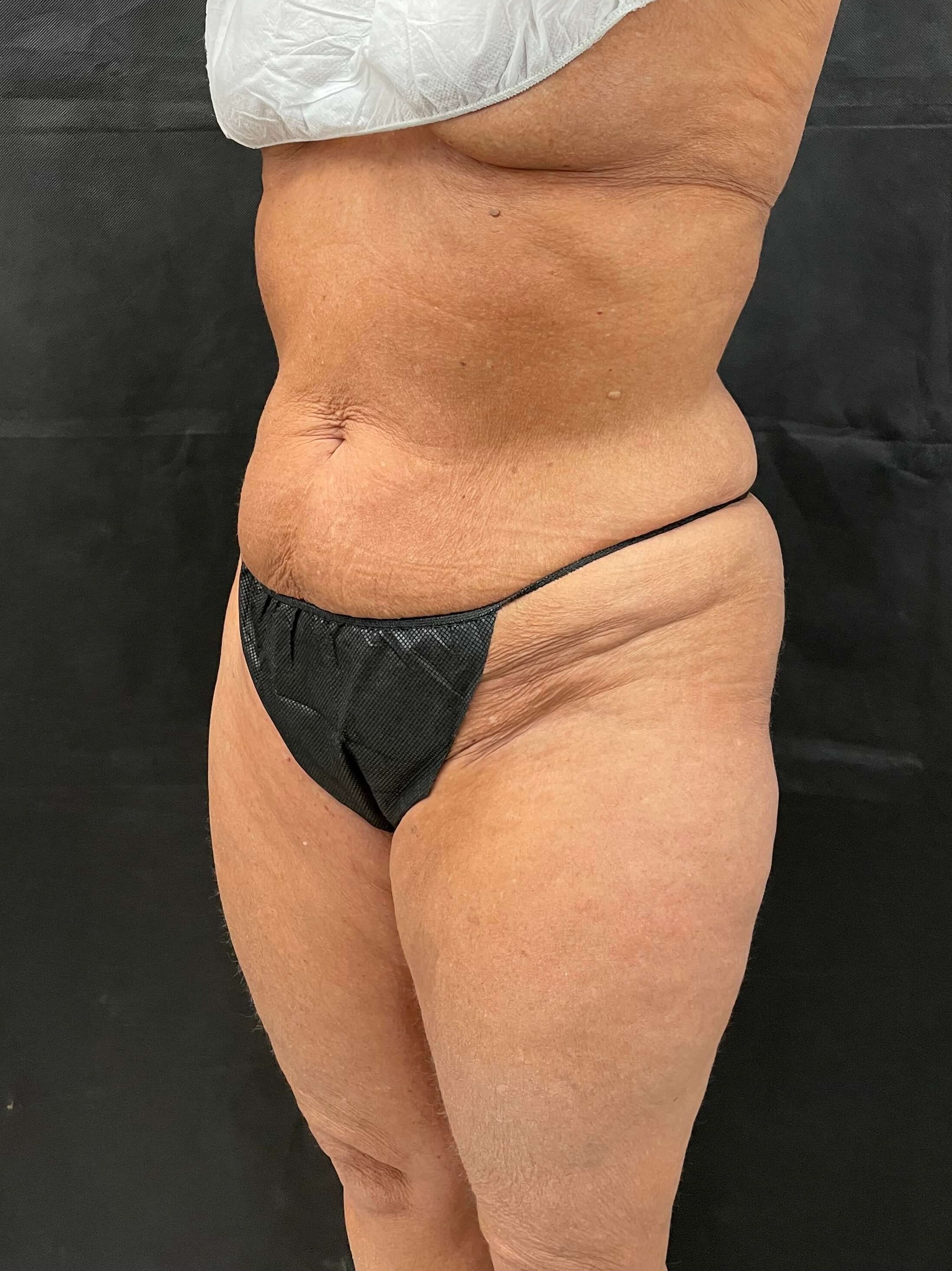 Abdomen and Flank Liposuction After Abdomen and Flank Liposuction After