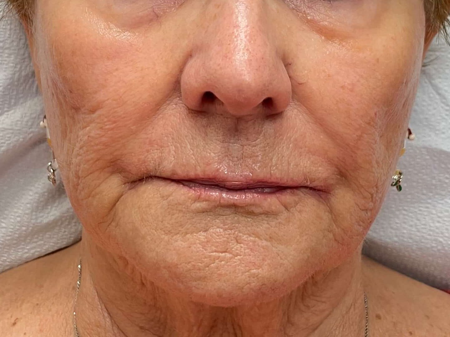 Radiesse in Cheeks Before