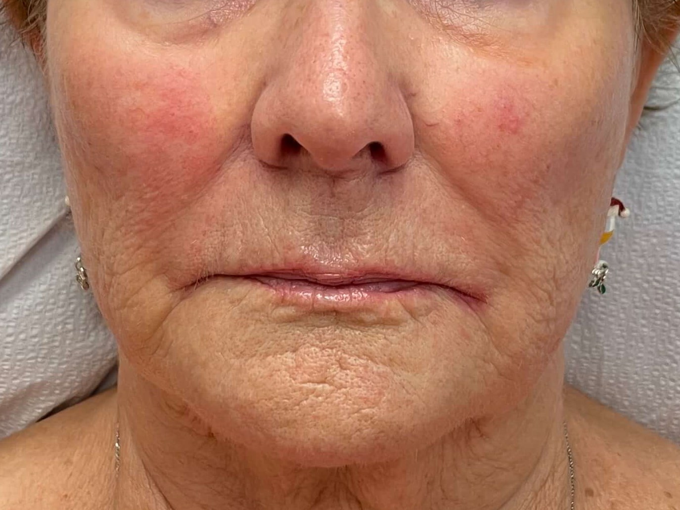 Radiesse in Cheeks After