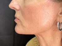 Thread Lift Before & After Photos
